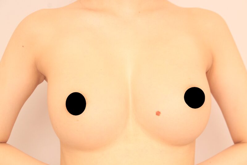 コンデンスリッチ豊胸の実力1年後