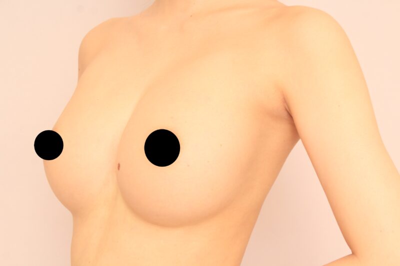 人生を変えるコンデンスリッチ豊胸1年後