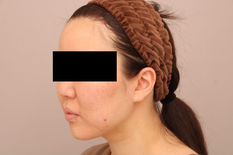 お顔の脂肪吸引 術後6ヵ月の経過