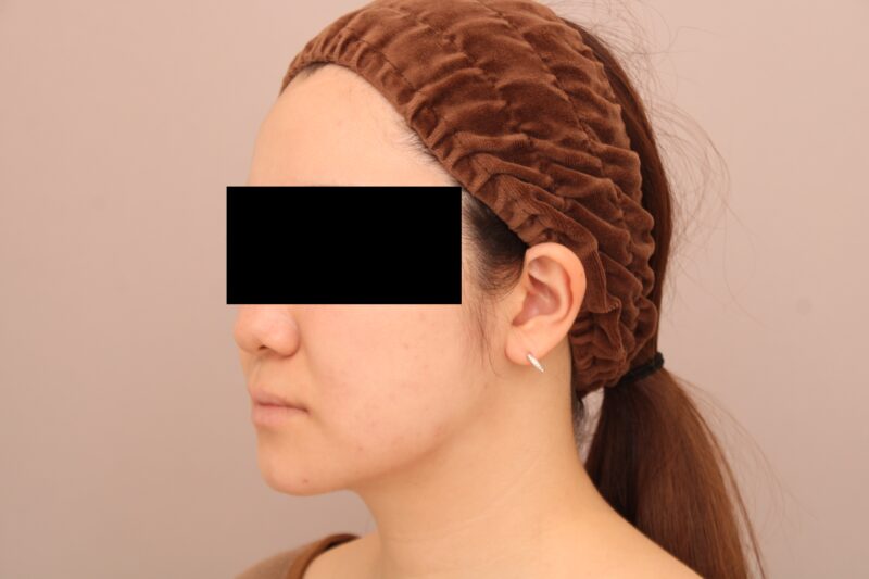 お顔の脂肪吸引 術後6ヵ月の経過