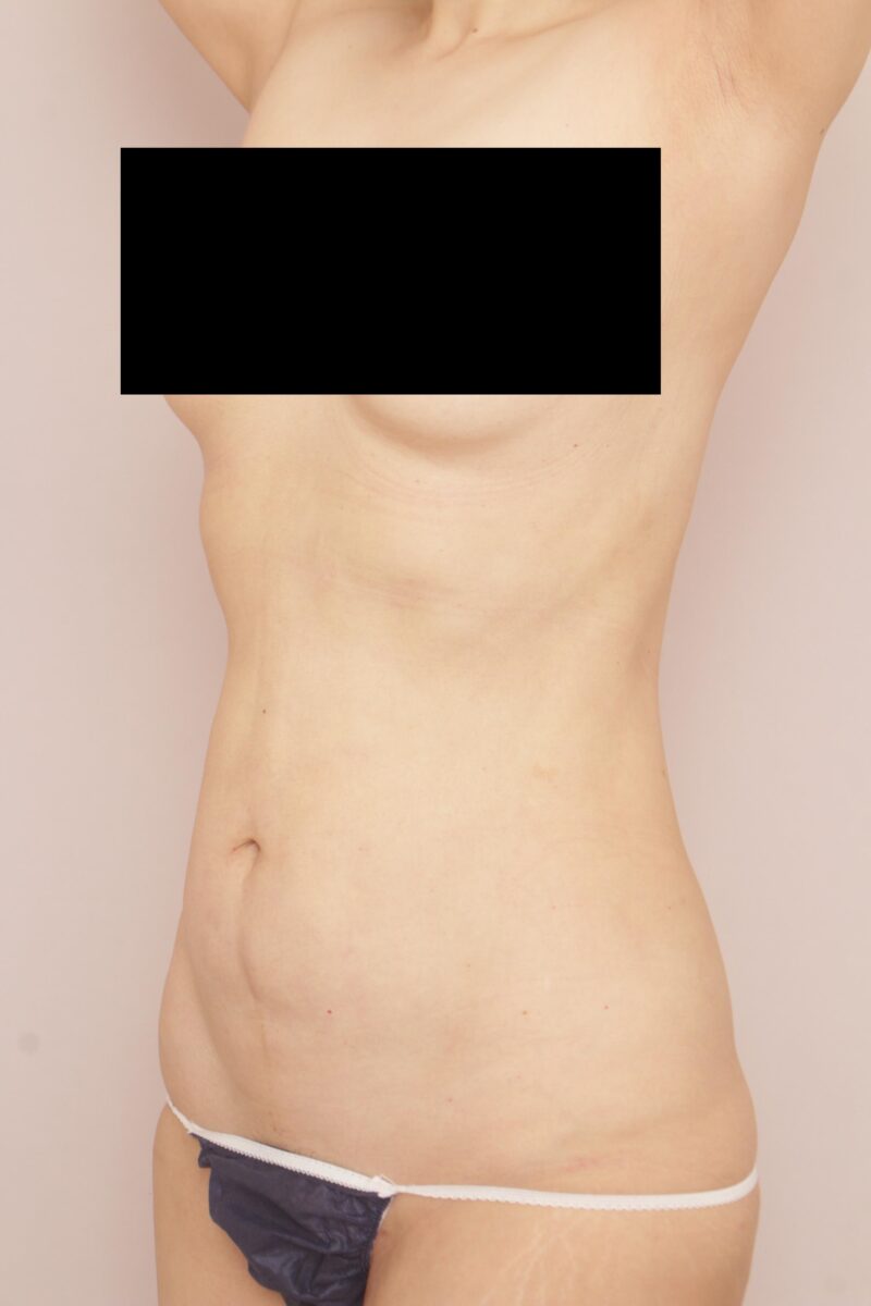 お腹全体胸下腰の脂肪吸引半年後