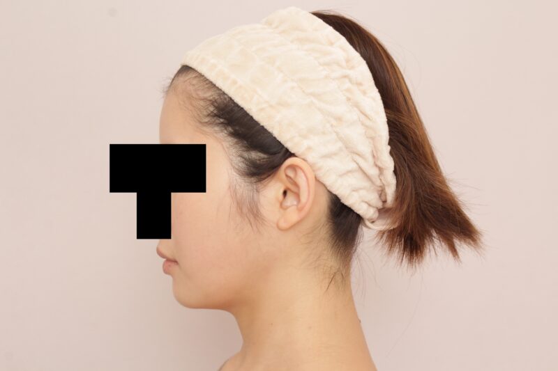 ほほ顎脂肪吸引で逆卵型の輪郭に♡3か月後