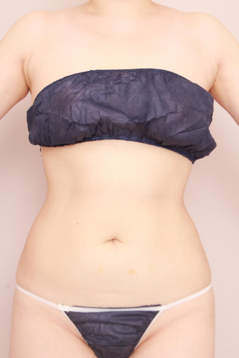 昨日のお腹は吸引していない方のお腹側の見た目の変化