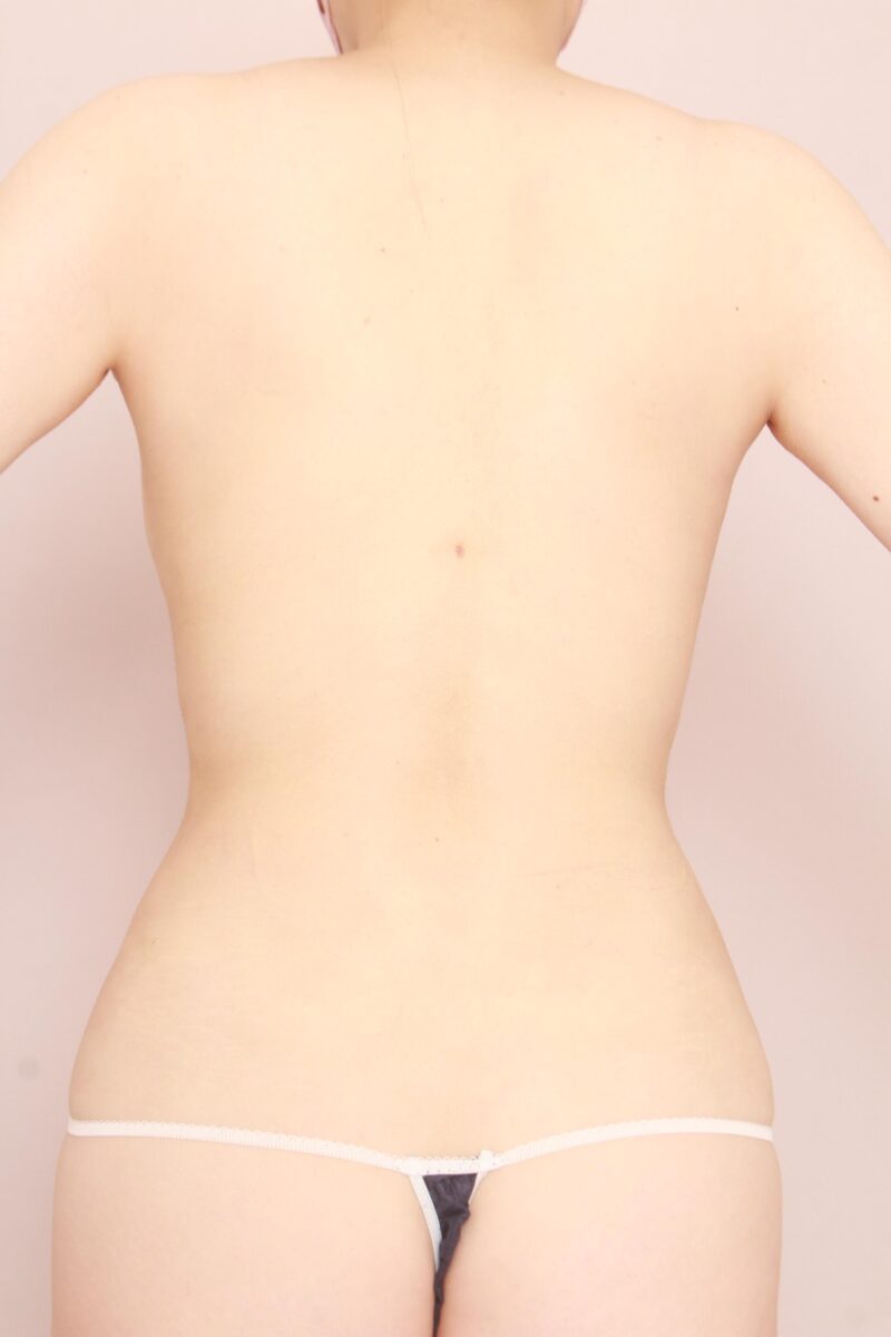 クビレが変わる!!腰、肩甲骨上下の脂肪吸引3か月後