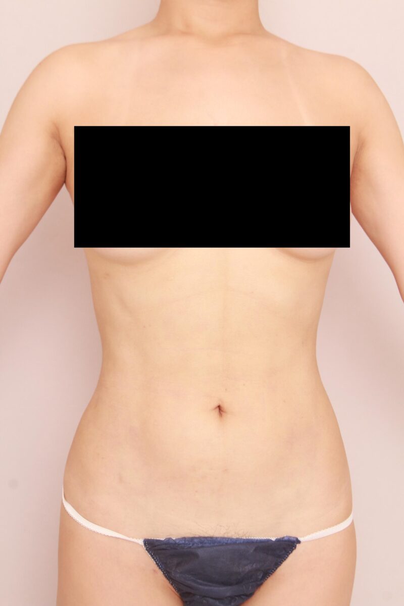 お腹全体胸下腰の脂肪吸引半年後