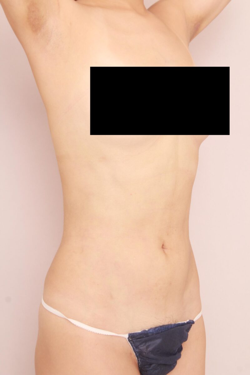 お腹全体胸下腰の脂肪吸引半年後