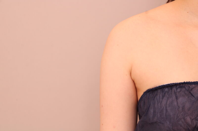 二の腕・肩の脂肪吸引 術後1ヵ月の経過