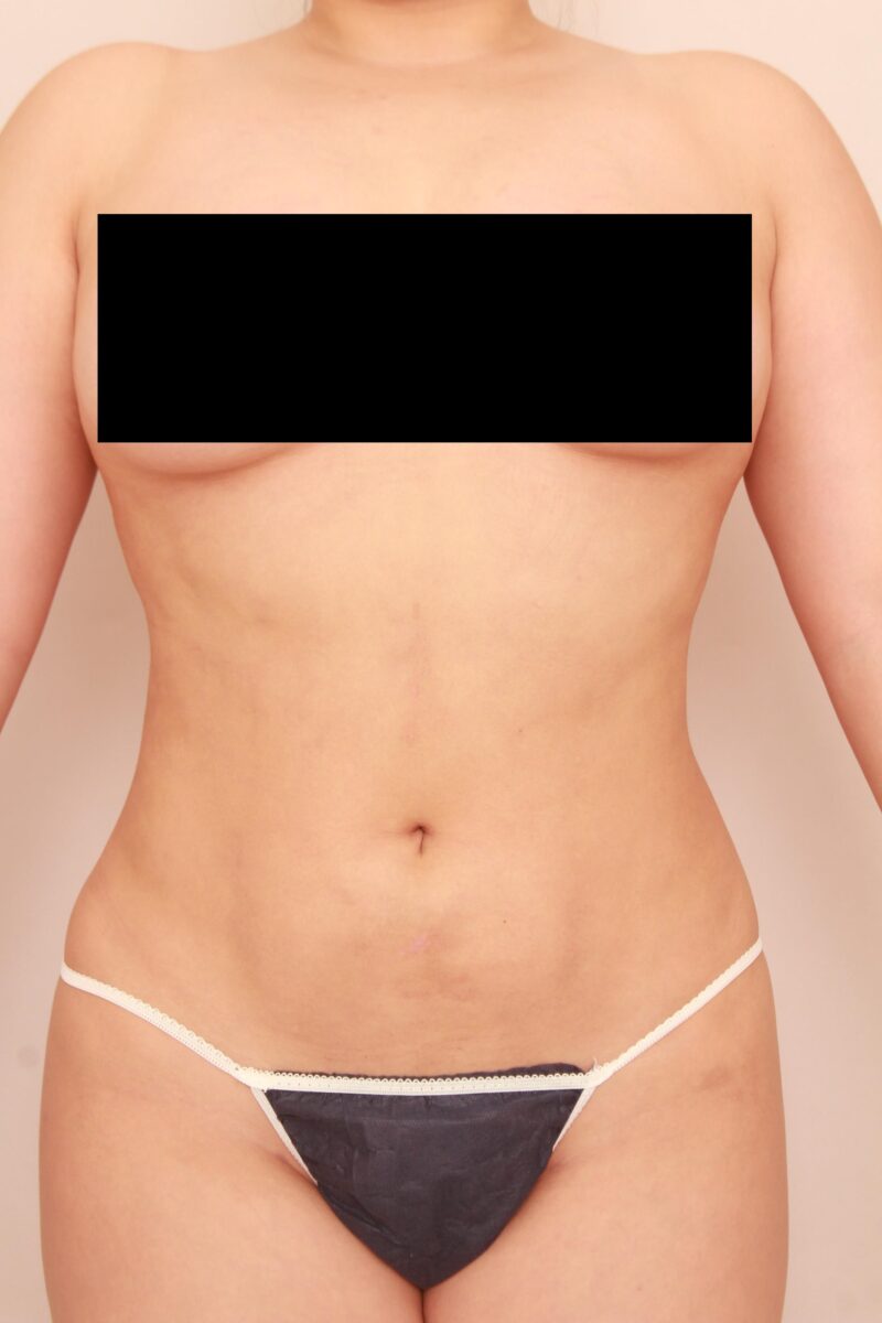 ブラジリアンバットリフトのモニター様のお腹の変化3か月後