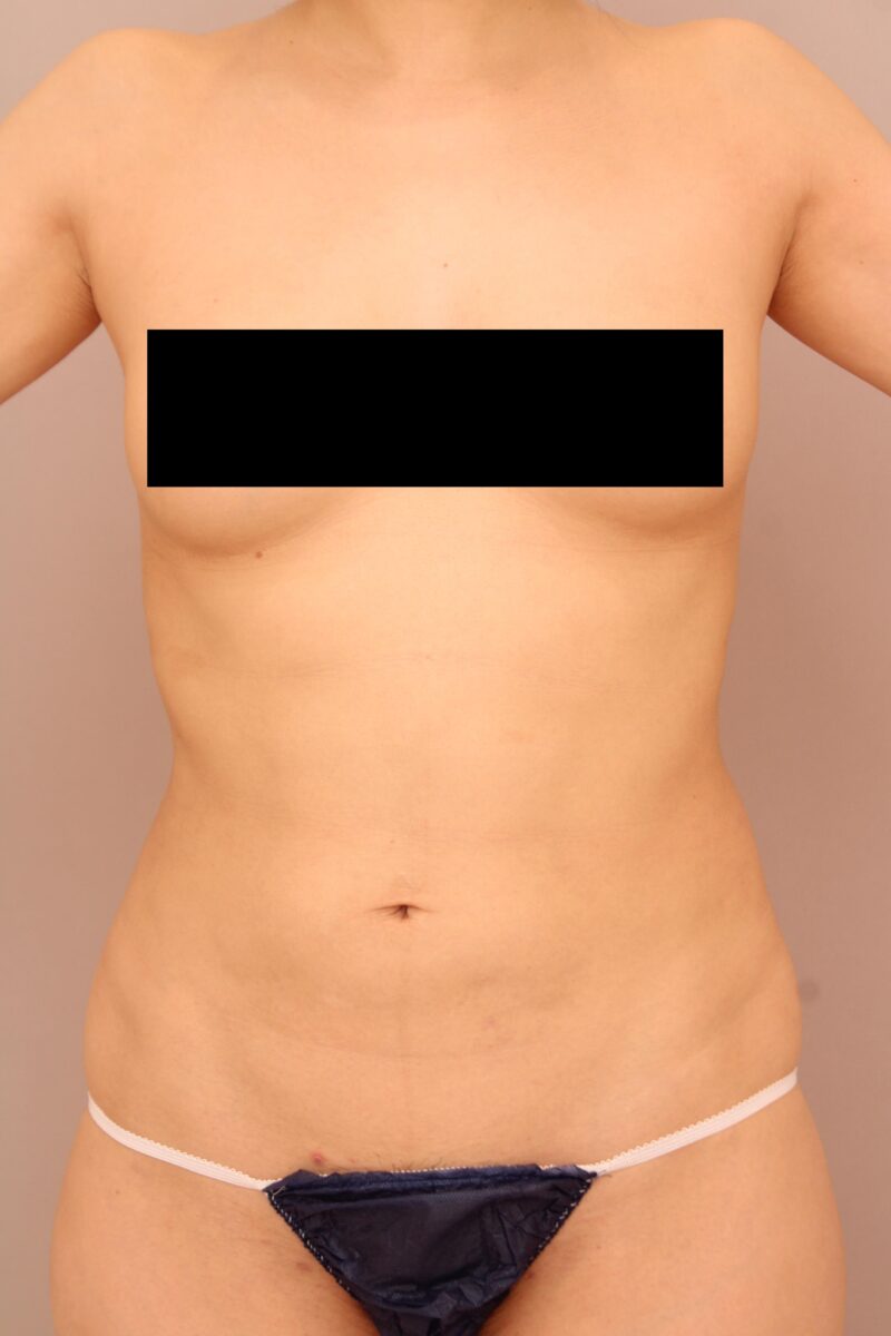 お腹・腰の脂肪吸引 術後3カ月の経過
