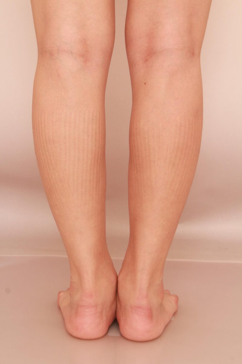 昨日の方の下腿足首の脂肪吸引の変化
