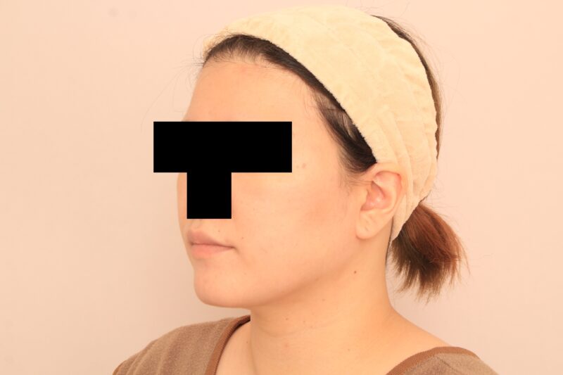 劇的変化のほほ顎脂肪吸引3か月後(ボァイエのお知り合い)