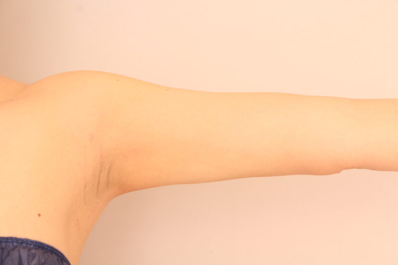 二の腕・肩の脂肪吸引 術後6カ月の経過