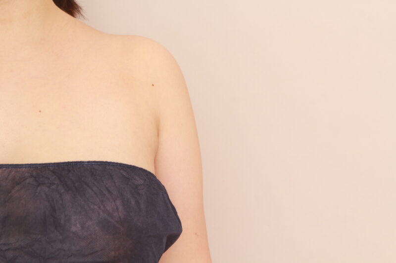 二の腕・肩の脂肪吸引 術後6ヵ月の経過