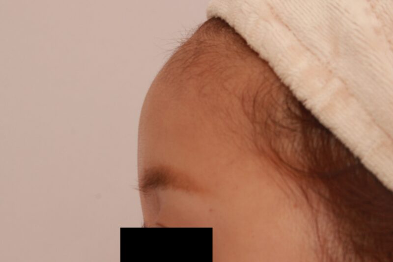 オデコこめかみの脂肪注入2か月後(しっかり前に出したいタイプ)