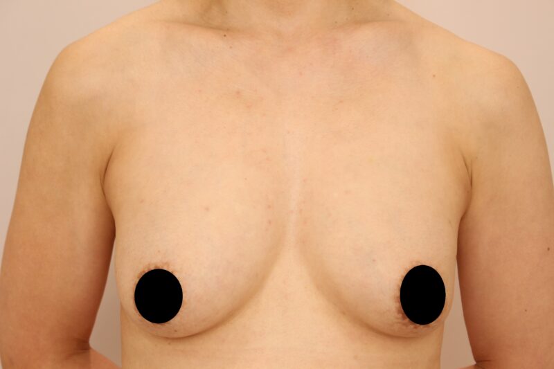 旦那様が大喜びなコンデンスリッチ豊胸♡半年後