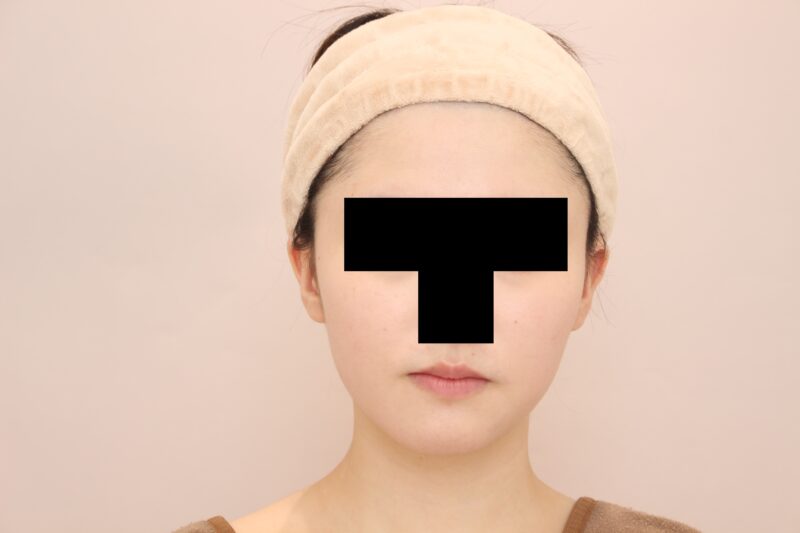 ほほ顎脂肪吸引3か月後♡見とれるフェイスラインに♪