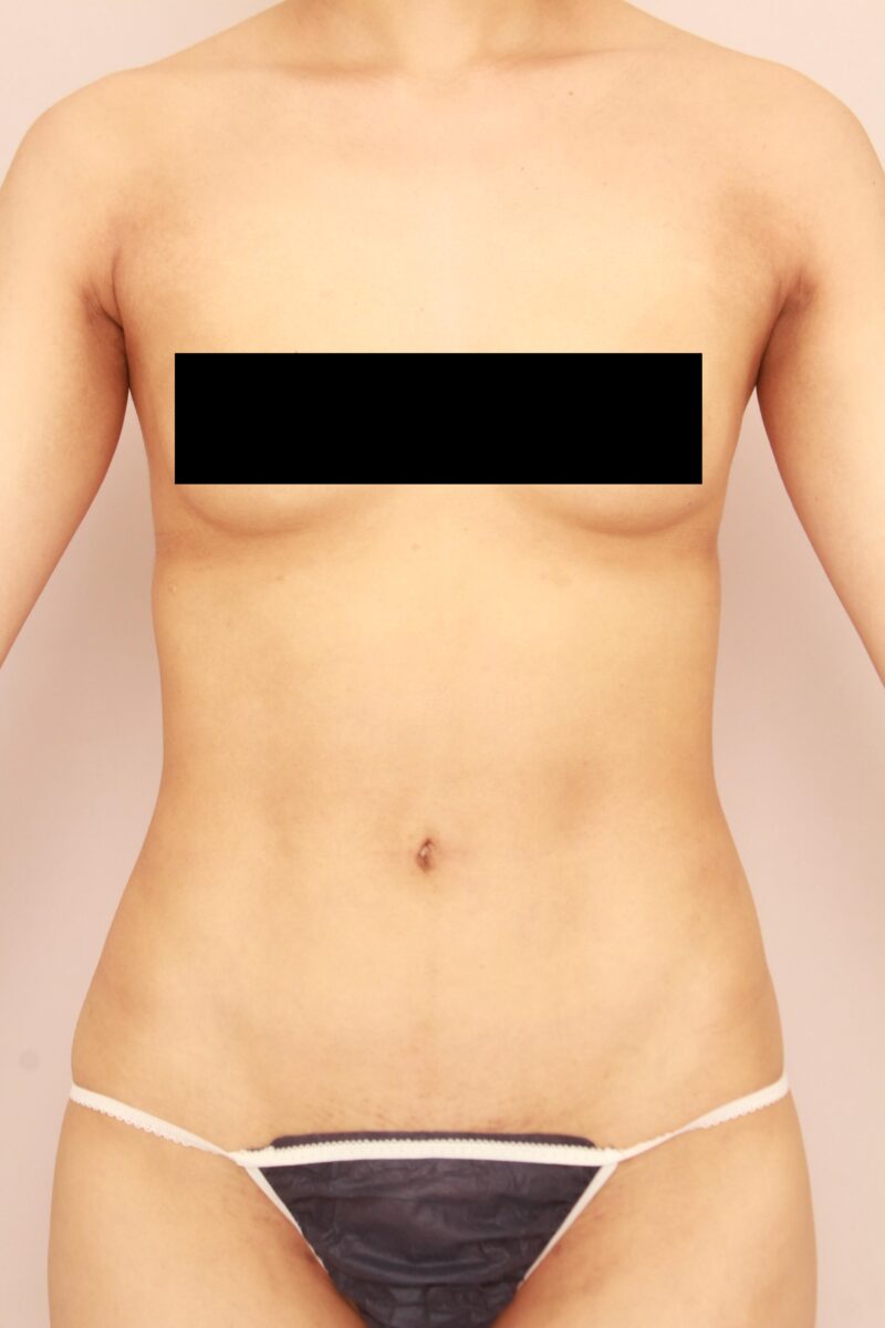 お腹・腰の脂肪吸引 術後6ヵ月の経過