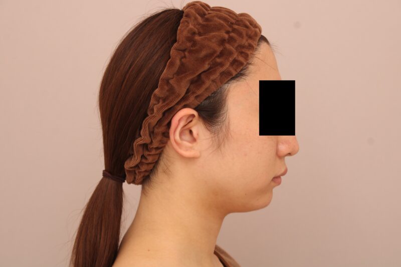 お顔の脂肪吸引 術後6ヵ月の経過