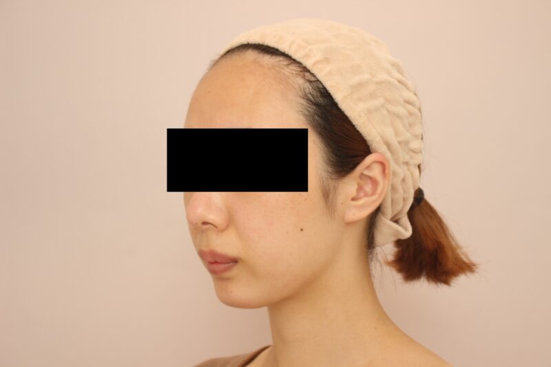 お顔の脂肪吸引 術後3カ月の経過