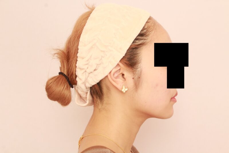 芸能人のような輪郭に♡まっすます美人さんな3か月後