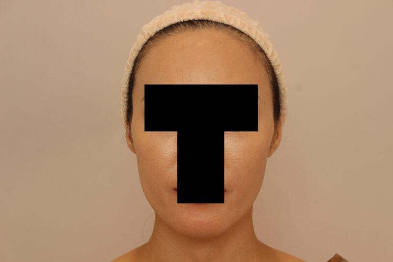 フェイスの脂肪注入でエイジングケア14か月後