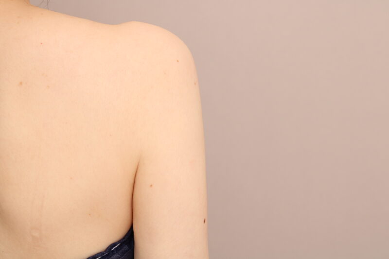 二の腕・肩の脂肪吸引 術後1ヵ月の経過