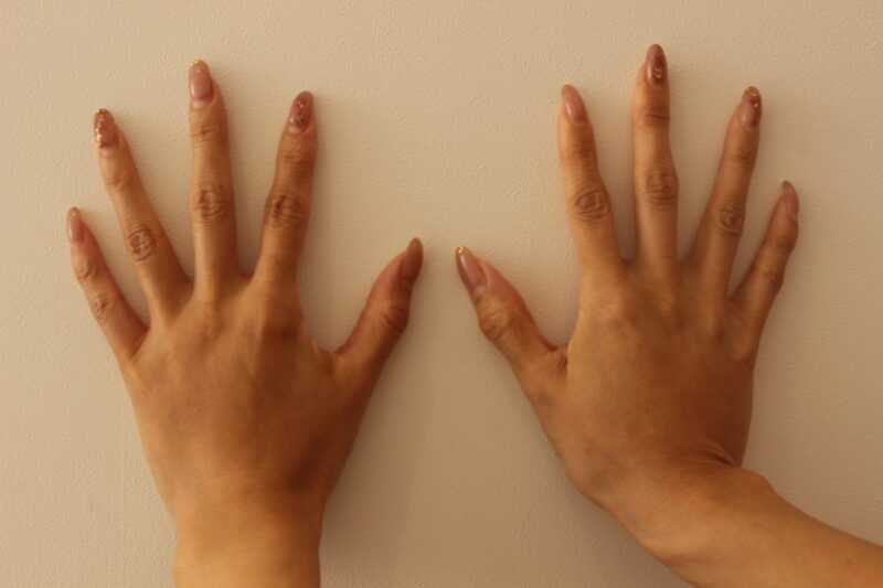 手の甲の脂肪注入14か月後