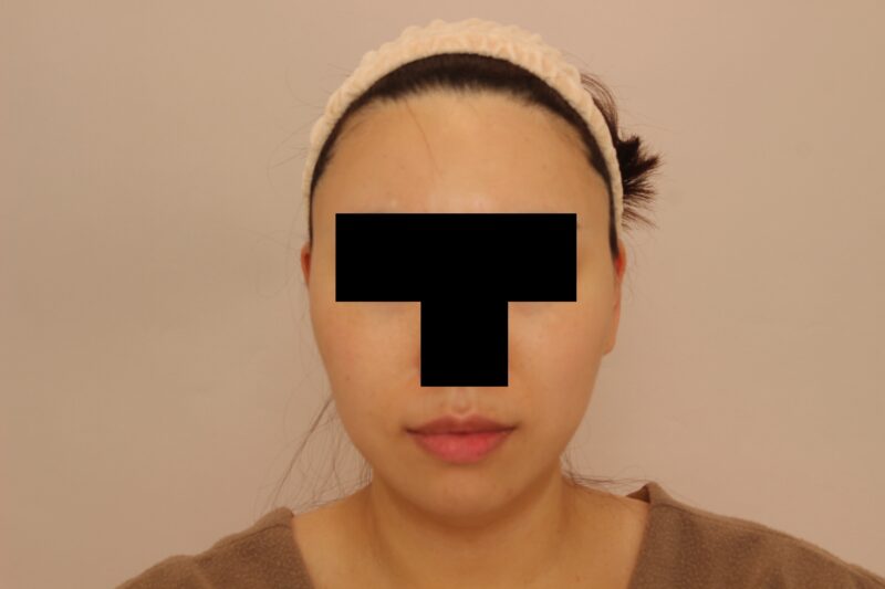 ほほ顎脂肪吸引のモニター様3か月後