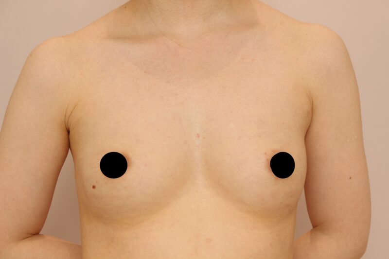 昨日の方のバストの変化です。