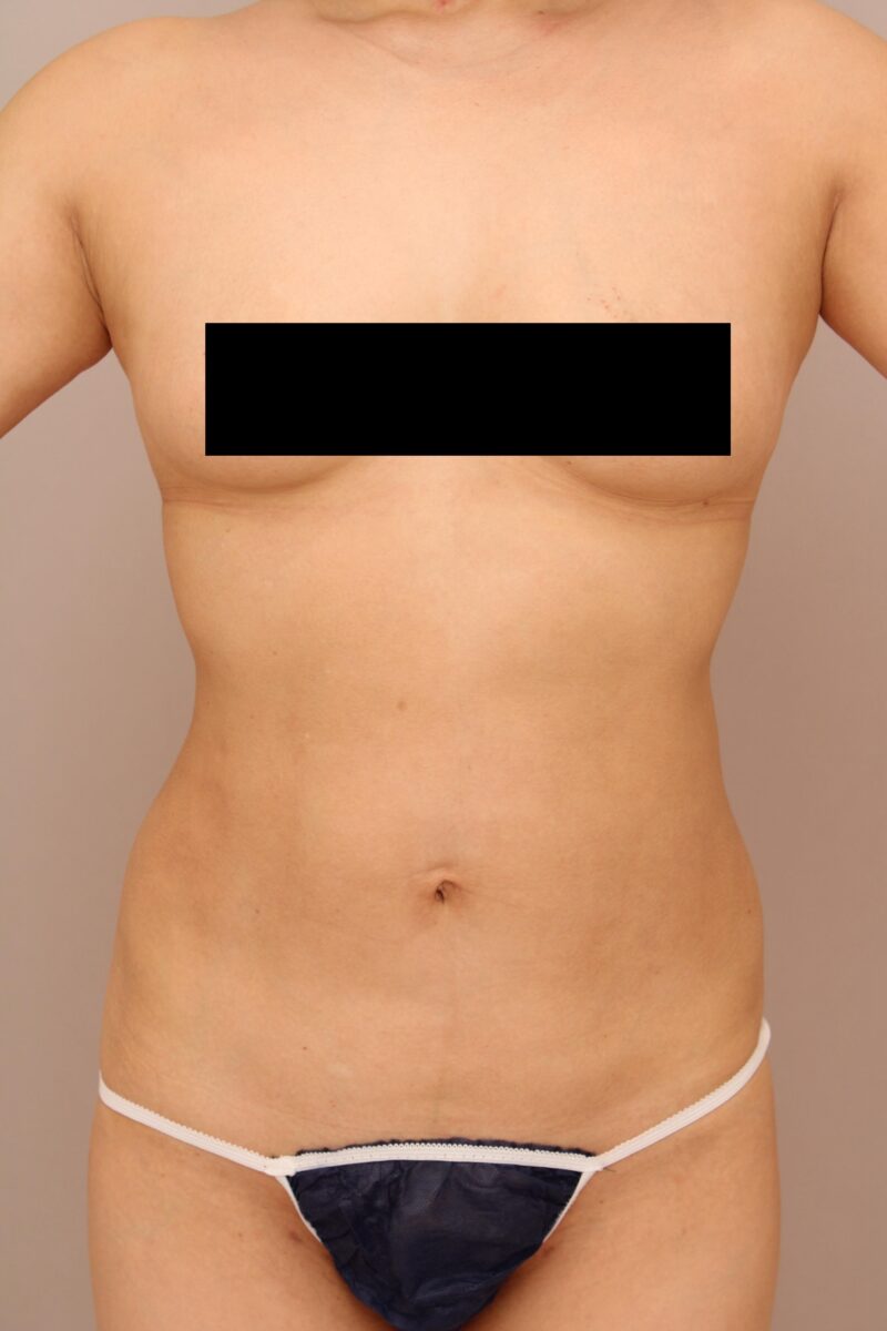お腹・腰の脂肪吸引 術後6ヵ月の経過
