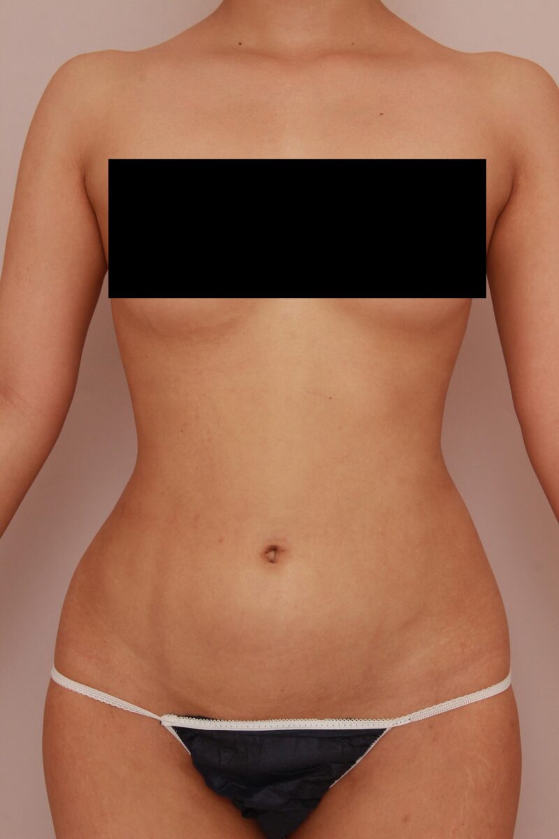 お腹全体胸下腰の脂肪吸引3か月後