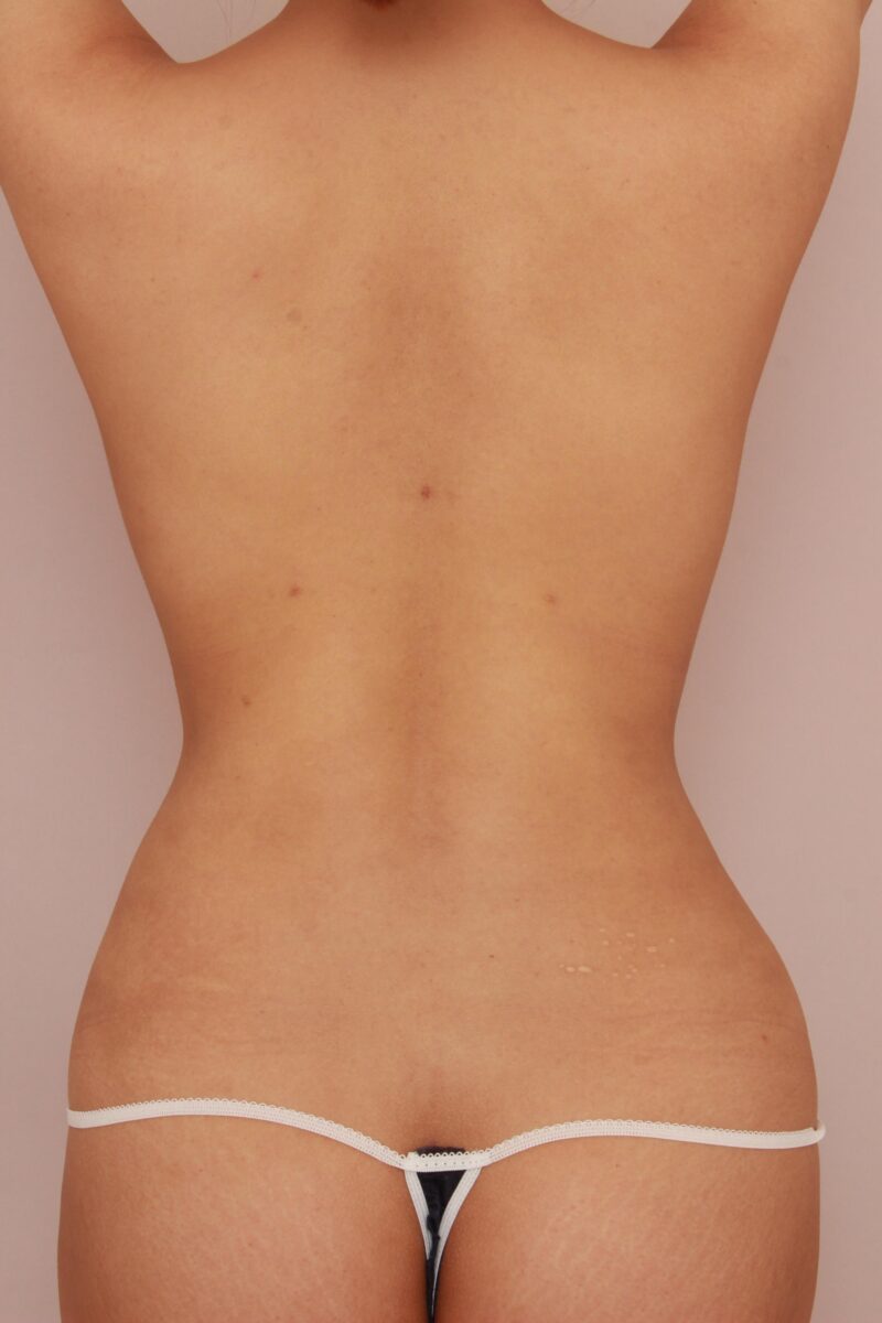 腰、背中の脂肪吸引の他院修正3か月後