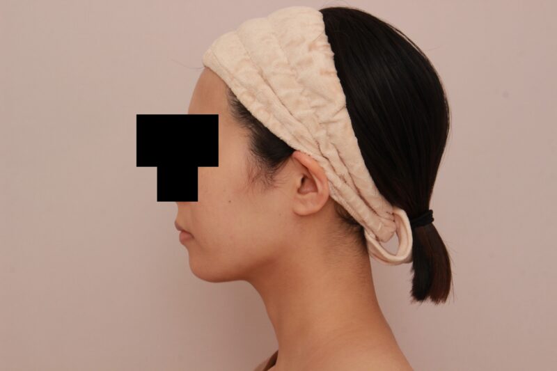 ほほ顎脂肪吸引でますます美人さんに♡