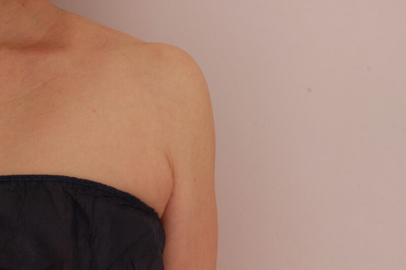 二の腕・肩の脂肪吸引 術後6ヵ月の経過