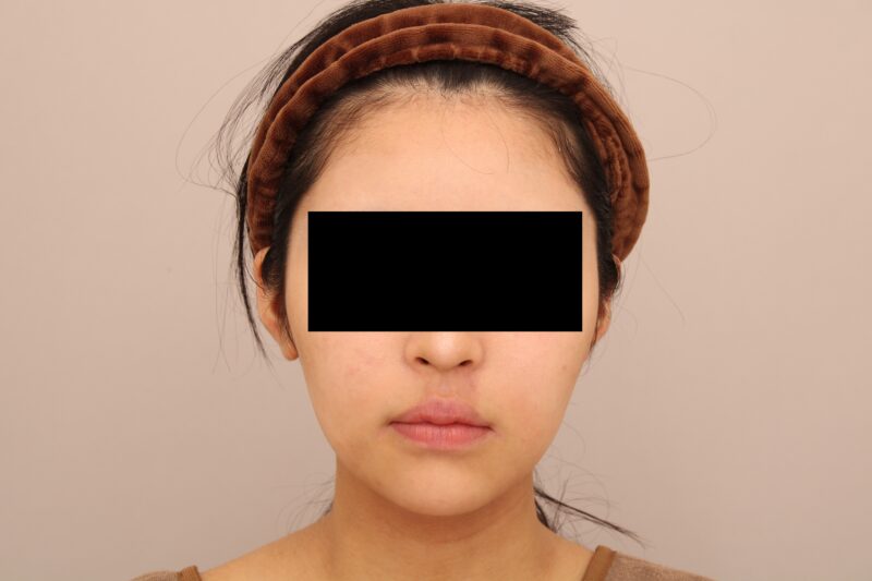 お顔の脂肪吸引 術後3ヵ月の経過