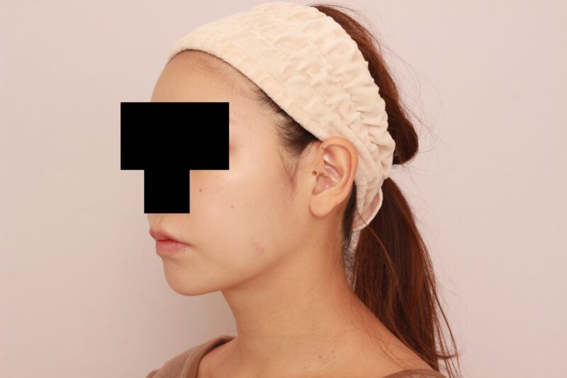 ほほ顎脂肪吸引しか勝タン!3か月後