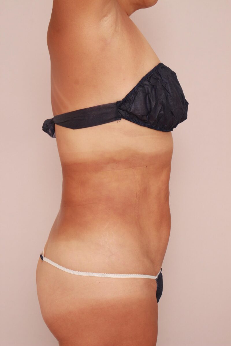 54歳158㎝74kgのモニター様お腹全体胸下腰の脂肪吸引半年後