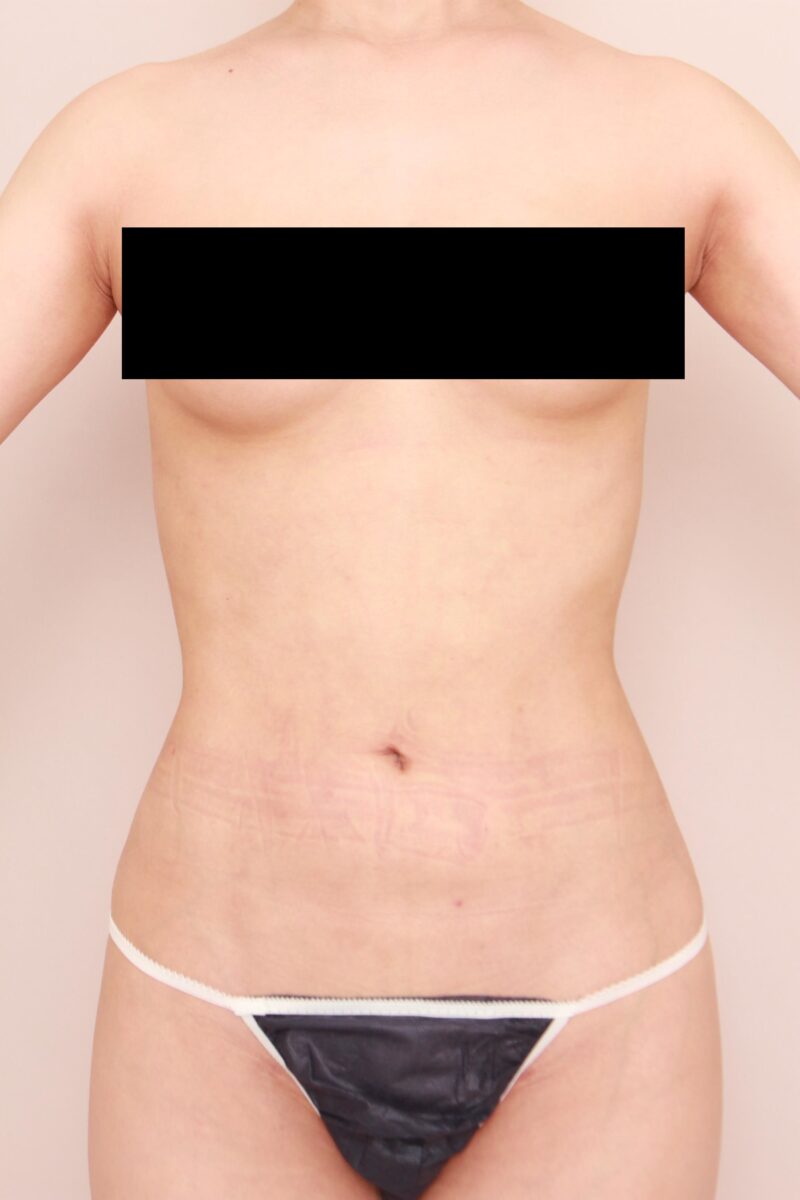 みんなで目指そう峰不二子♡お腹全体胸下腰の脂肪吸引3か月後