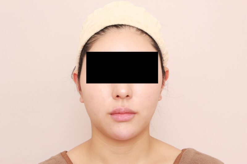 お顔の脂肪吸引 術後3カ月の経過