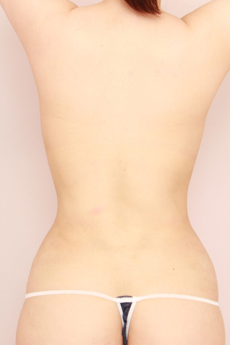 ３か月で劇的変化なお腹全体胸下腰の脂肪吸引♡