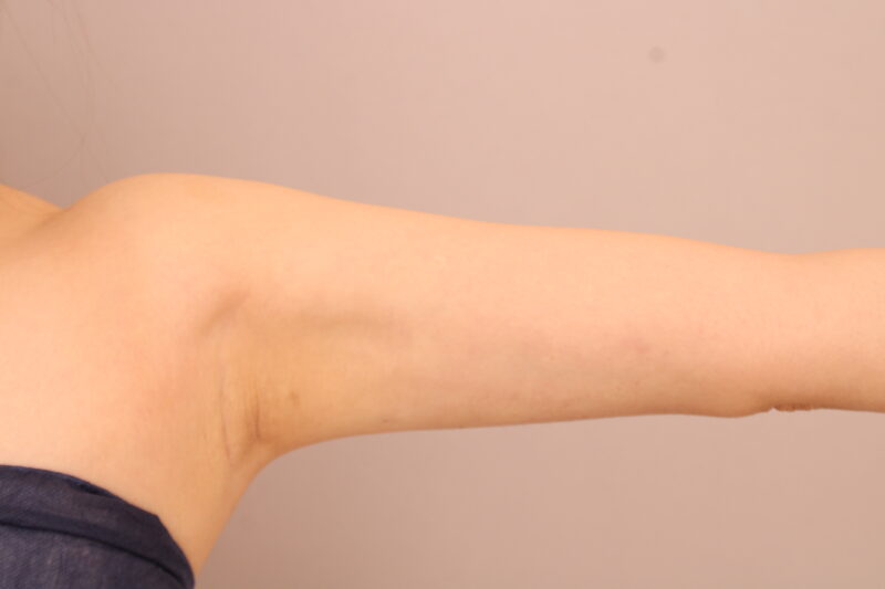 二の腕・肩の脂肪吸引 術後3カ月の経過