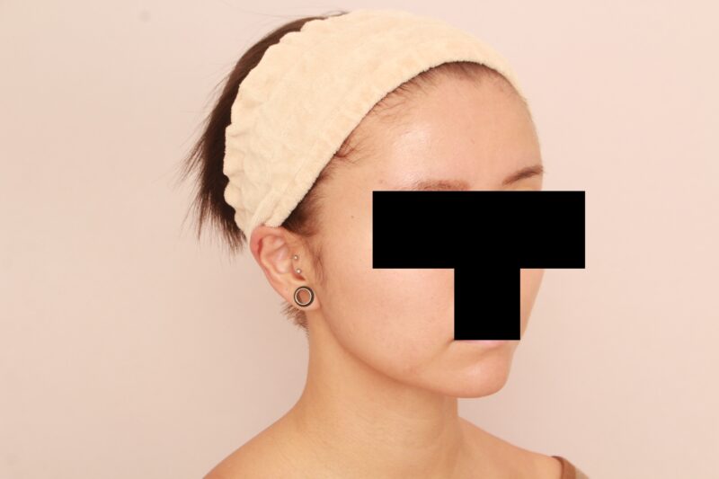 オデコこめかみの脂肪注入で可愛らしい印象に♡