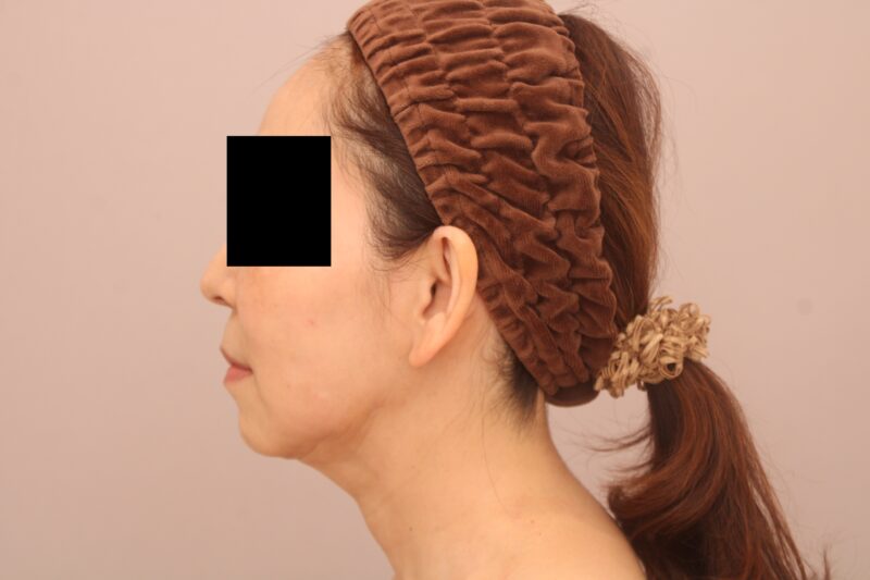 お顔の脂肪吸引 術後1ヵ月の経過