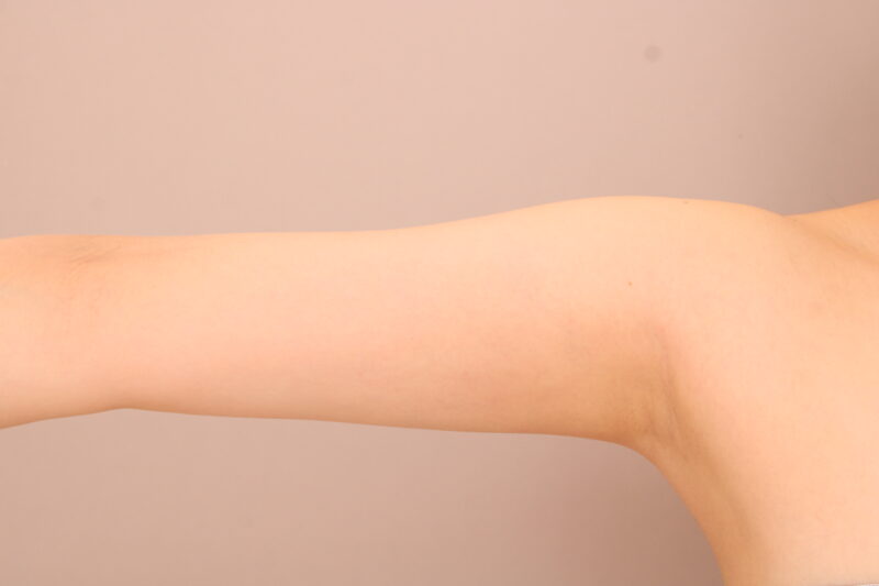 二の腕・肩の脂肪吸引 術後3ヵ月の経過