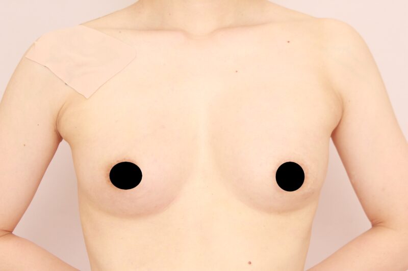 授乳後のコンデンスリッチ豊胸がオススメな理由♡