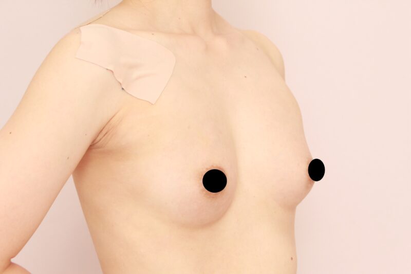 コンデンスリッチ豊胸が授乳後の方がオススメな方とは、、、