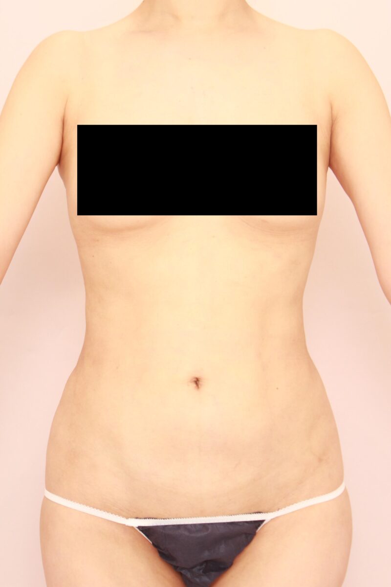 お腹全体胸下腰の脂肪吸引3か月後♡