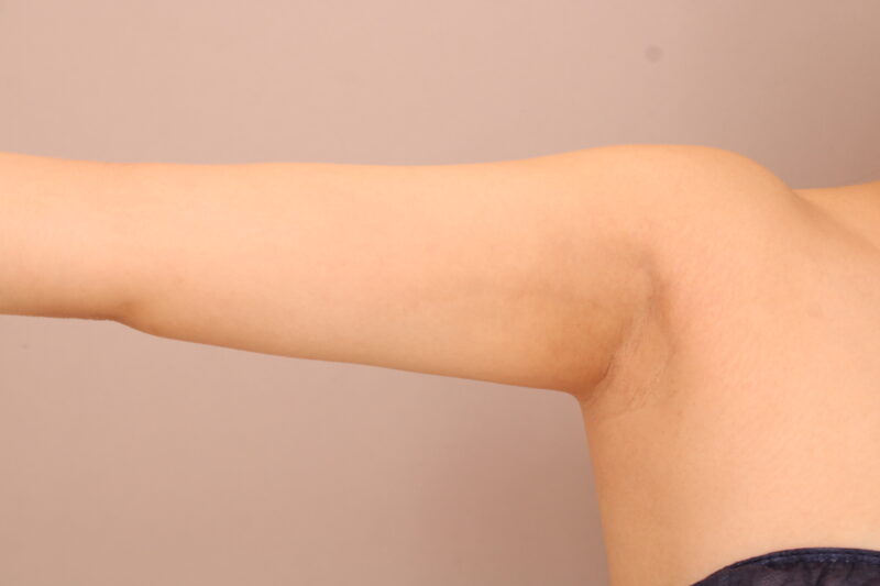 二の腕・肩の脂肪吸引 術後6ヵ月の経過