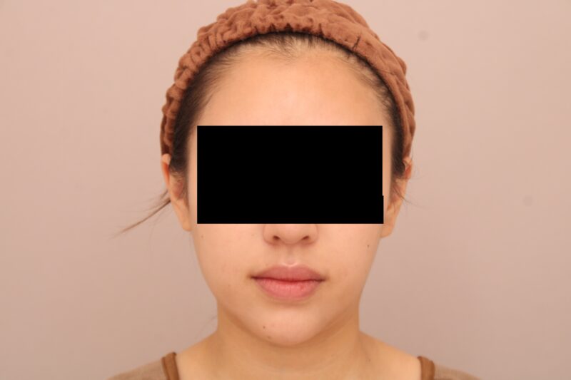 お顔の脂肪吸引 術後6ヵ月の経過