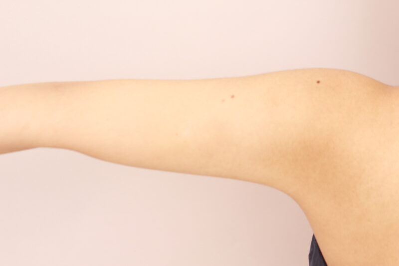 二の腕の脂肪吸引でシルエットを変えよう♪半年後